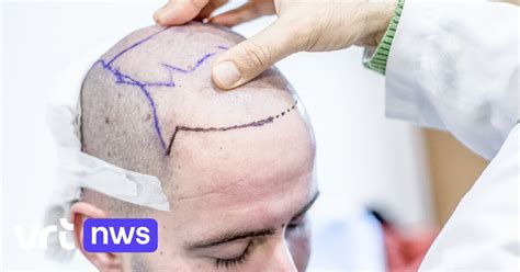 Haartransplantatie Technologie: Innovaties Van Vandaag