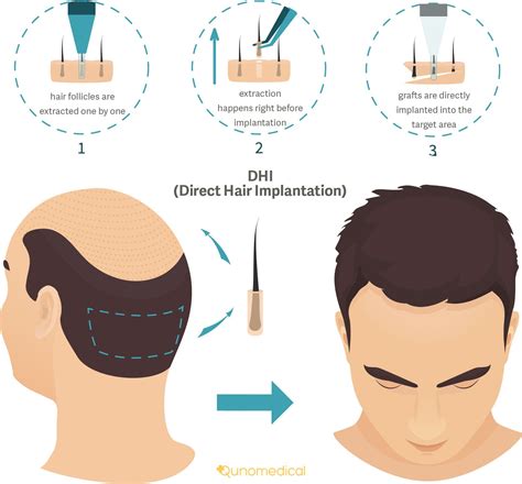 Haartransplantatie Vergelijking: FUE Vs. DHI Methode