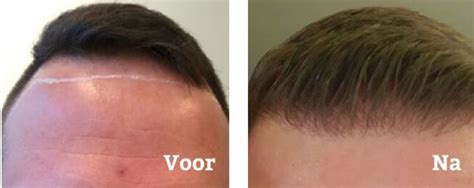 Haartransplantatie: Wanneer Is Het Tijd Voor Een Behandeling?