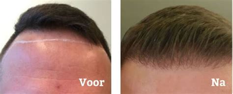 Haartransplantatie En Leeftijd: Wanneer Is De Juiste Tijd?