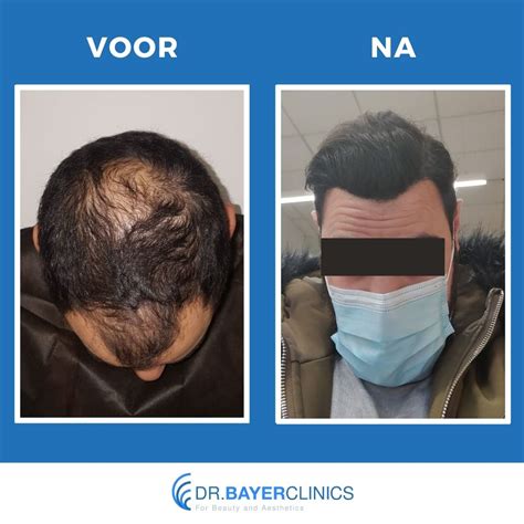 Haartransplantatie Voor En Na Foto’s: Realistische Verwachtingen