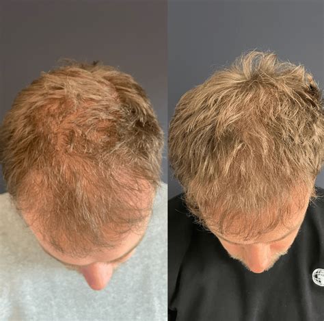 Kapitaal Besparen Op Haartransplantatie: Hoe Te Doen?