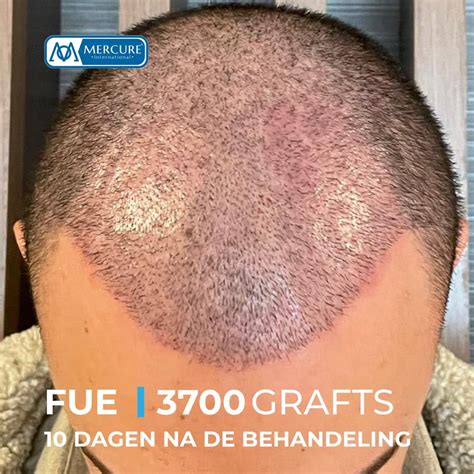 Saffier FUE: De Nieuwste Technologie In Haartransplantatie