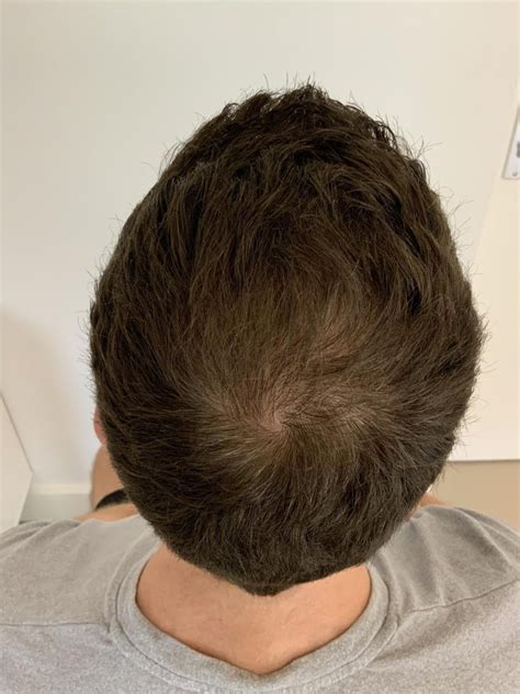 Verschillende Soorten Haartransplantatie Behandelingen