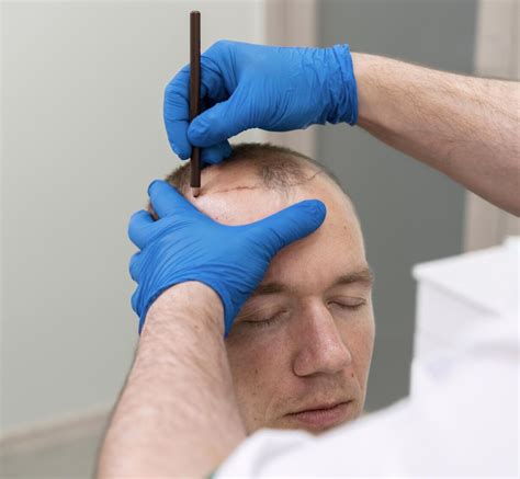 Haartransplantatie En De Psychologie Van Haarverlies