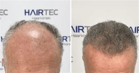 Haartransplantatie En Het Herstelproces: Tips En Adviezen