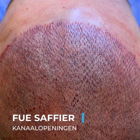 Saffier FUE Haartransplantatie: Een Nieuwe Doorbraak