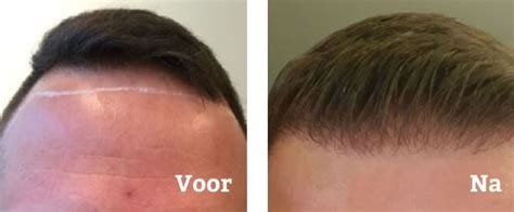 Verbeter Je Haarlijn Met Haartransplantatie