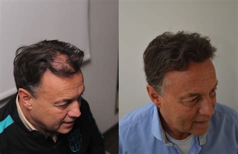 Haartransplantatie Voor Mannen: Een Volledige Gids