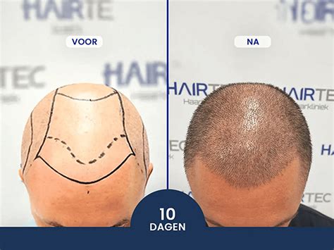 Beste Haartransplantatie Methoden: Een Vergelijking