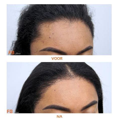 Haartransplantatie Bij Vrouwen: Feiten En Fabels