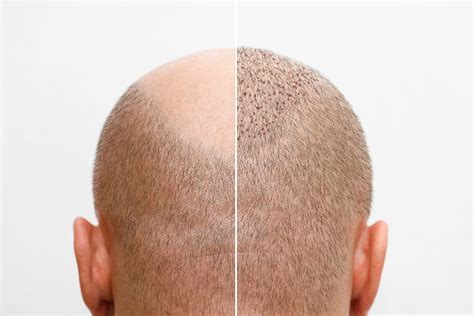 Herstel Na Haartransplantatie: Tips Voor Een Snel Proces