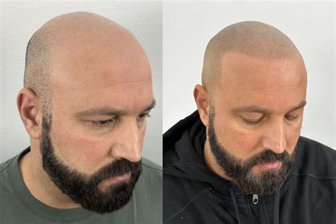Kaalheid Bij Mannen: Is Haartransplantatie De Oplossing?