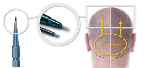 Saffier FUE: Een Innovatieve Haartransplantatiemethode